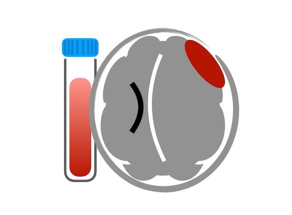 Warfarin bleeding